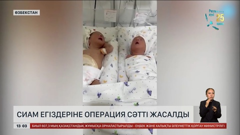 Өзбекстанда сиам егіздерін ажырату операциясы сәтті жасалды
